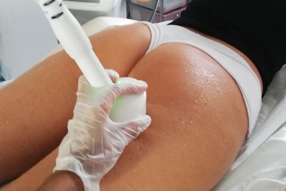 Lipo-Cavitation & Radio Frequency