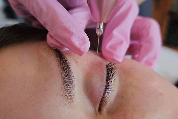 Plasma Skin Tightening
